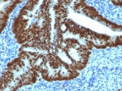 CDX2 Antibody Human Colon Carcinoma Tissue IHC. Immunohistochemistry testing of FFPE human colon carcinoma with CDX2 antibody (clone CDX2/1690). Required HIER: boil sections in 10mM citrate buffer, pH6, for 10-20 min.