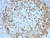 TOP2A Antibody / Chromosome Segregation Enzyme Antibody (clone TOP2A/1362). Immunohistochemistry analysis of FFPE human tonsil tissue demonstrates strong nuclear staining consistent with expression of the chromosome segregation enzyme DNA Topoisomerase II alpha in proliferating lymphoid cells. Nuclear immunoreactivity is concentrated within germinal center lymphocytes, reflecting the high mitotic activity of these cells during immune responses. The Chromosome Segregation Enzyme Antibody highlights proliferating germinal center B cells where mitotic chromosome segregation and chromatid decatenation are actively occurring, while surrounding mantle zone lymphocytes show minimal staining. Required HIER: boil tissue sections in pH 9 Tris-EDTA buffer for 10-20 min followed by cooling at RT for 20 min prior to immunohistochemistry staining.