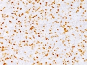 TOP2A Antibody Bladder Cancer IHC. Immunohistochemistry testing of FFPE human bladder carcinoma with TOP2A antibody (clone TOP2A/1362). Required HIER: boil sections in pH 9 10mM Tris with 1mM EDTA for 10-20 min followed by cooling at RT for 20 min.