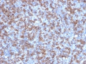 CD8A Antibody Lymphoma IHC. Immunohistochemistry analysis of CD8 alpha (CD8A) in FFPE human lymphoma tissue shows strong membranous staining of infiltrating cytotoxic T lymphocytes within the tumor microenvironment, consistent with CD8A expression as a cytotoxic T cell marker and supporting identification of effector T cell populations in lymphoid malignancy. Heat-induced epitope retrieval was performed in 10 mM citrate buffer, pH 6.0, for 10-20 minutes followed by cooling at room temperature.