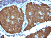 Neuron Specific Enolase Antibody Human Pheochromocytoma IHC. testing of FFPE human pheochromocytoma with Neuron Specific Enolase antibody (clone ENO2/1462). Required HIER: boil sections in 10mM citrate buffer, pH6, for 10-20 min.