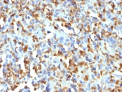 Immunohistochemistry of Factor XIIIa antibody in human histiocytoma. FFPE human histiocytoma tissue was stained with human tissue array validated Factor XIIIa antibody clone F13A1/1683. Strong cytoplasmic HRP-DAB brown staining is observed in numerous spindle-shaped and histiocytic tumor cells, consistent with known Factor XIII A chain expression in fibrohistiocytic lesions. Surrounding stromal elements show minimal to absent staining. Heat induced epitope retrieval was performed by boiling tissue sections in 10 mM citrate buffer, pH 6, for 10-20 minutes prior to antibody incubation.
