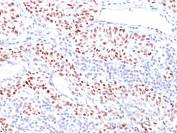 IHC: Formalin-fixed, paraffin-embedded human bladder carcinoma stained with TP53 antibody (TRP/816). Required HIER: boil tissue sections in 10mM Citrate buffer, pH 6.0, for 10-20 min followed by cooling at RT for 20 min.