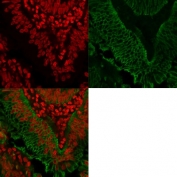 EpCAM Antibody Colorectal Carcinoma IF. Immunofluorescent staining of FFPE human colorectal carcinoma tissue using EpCAM Antibody / Epithelial Cell Marker Antibody demonstrates strong membranous green fluorescence outlining neoplastic epithelial cells throughout the tumor glands. The staining pattern is consistent with expression of Epithelial Cell Adhesion Molecule (EPCAM/CD326), a cell surface glycoprotein involved in epithelial cell adhesion, tissue organization, and epithelial lineage maintenance. Prominent membrane-associated staining highlights the epithelial origin of the carcinoma cells and reflects the established use of EpCAM as a marker of epithelial differentiation and epithelial-derived malignancies. Nuclei are counterstained with Reddot (red), providing clear visualization of tissue architecture and cellular localization. The observed staining supports the utility of EpCAM for identification and characterization of epithelial tumor cell populations in colorectal carcinoma specimens.