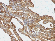 EpCAM Antibody Colorectal Carcinoma IHC. Immunohistochemistry staining of FFPE human colorectal carcinoma tissue using EpCAM Antibody / Epithelial Cell Marker Antibody (clone EGP40/1372) demonstrates strong membranous HRP-DAB brown staining throughout neoplastic gland-forming epithelial cells. The staining pattern is consistent with expression of Epithelial Cell Adhesion Molecule (EPCAM/CD326), a transmembrane glycoprotein involved in epithelial cell adhesion, maintenance of tissue architecture, and regulation of cellular signaling pathways. Prominent circumferential membrane staining highlights the epithelial origin of the carcinoma cells and reflects the established expression of EpCAM in colorectal epithelial tissues and colorectal carcinomas. The observed staining supports the use of EpCAM as a marker for epithelial differentiation, tumor cell identification, and characterization of epithelial-derived malignancies. Required HIER: steam tissue sections in pH 9 Tris-EDTA buffer (10 mM Tris, 1 mM EDTA) for 10-20 minutes prior to staining.