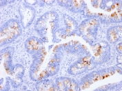 IHC staining of FFPE human colon with CEA antibody (clone C66/1291). HIER: boil tissue sections in pH 9 10mM Tris with 1mM EDTA for 10-20 min and allow to cool before testing.