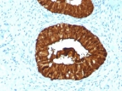 IHC testing of FFPE human cervical carcinoma with MAML3 antibody (clone MAML3/1303). Staining of FFPE tissue requires boiling sections in 10mM Tris with 1mM EDTA, pH9, for 10-20 min followed by cooling at RT for 20 min.