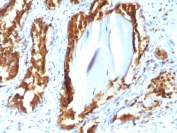 PSAP Antibody Recombinant Mouse MAb rACPP/1338 immunohistochemistry analysis of Prostatic acid phosphatase / ACP3 in human prostate carcinoma tissue. FFPE human prostate carcinoma tissue was stained with PSAP Antibody Recombinant Mouse MAb rACPP/1338 following heat induced epitope retrieval by boiling tissue sections in 10mM citrate buffer (pH 6) for 10-20 minutes and cooling at room temperature prior to staining. HRP-DAB brown chromogenic signal highlights strong cytoplasmic and membranous staining of prostate tumor epithelial cells forming glandular carcinoma structures, consistent with the known localization of Prostatic acid phosphatase (ACP3 / PAP) in prostate-derived epithelial cells. Detection of PSAP expression by immunohistochemistry is widely used in prostate cancer research to identify prostate epithelial lineage and evaluate PAP expression in prostate carcinoma tissues.