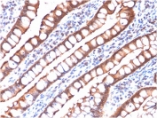 Villin Antibody. Immunohistochemistry analysis of Villin-1 (VIL1) in FFPE human small intestine carcinoma using Villin Antibody / Brush Border Cytoskeletal Protein Antibody with recombinant mouse monoclonal clone rVIL1/1325. Strong HRP-DAB brown staining is observed along the apical membrane of tumor epithelial cells, clearly outlining glandular luminal surfaces and highlighting preserved brush border-like structures within malignant tissue. The predominantly membranous apical staining pattern is consistent with Villin localization to microvilli-rich brush border regions and supports its role as a brush border cytoskeletal protein in intestinal epithelium.