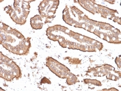 Villin Antibody. Immunohistochemistry analysis of Villin-1 (VIL1) in FFPE human small intestine carcinoma using Villin Antibody / Brush Border Cytoskeletal Protein Antibody with recombinant mouse monoclonal clone rVIL1/1325. Strong HRP-DAB brown staining highlights the apical membrane of tumor epithelial cells, outlining glandular and villus-like structures with a distinct luminal pattern consistent with brush border localization. The predominantly membranous apical signal emphasizes microvilli-associated staining and supports Villin as a brush border cytoskeletal protein in intestinal-type carcinoma.