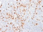 Recombinant Human IgG Antibody rIG266 in Human Tonsil IHC. Immunohistochemistry staining of FFPE human tonsil with Recombinant Human IgG Antibody clone rIG266 demonstrates distinct brown staining in a subset of cells distributed throughout the lymphoid tissue, with surrounding cells largely unstained. The staining pattern is consistent with selective detection of IgG-producing cells within the tonsil. This microarray validated antibody provides specific recognition of human IgG in the tested tissue.
