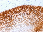 CD44v4 Antibody for IHC Cervical Squamous Cell Carcinoma. Immunohistochemistry analysis of CD44 variant 4 / CD44 expression in FFPE human cervical squamous cell carcinoma using recombinant mouse monoclonal antibody clone rCD44v4/1219. Strong membranous HRP-DAB brown staining is observed in malignant squamous epithelial cells forming cohesive sheets, clearly outlining cell borders and highlighting preserved epithelial organization consistent with CD44v4-associated tumor architecture and structural integrity. The staining pattern emphasizes uniform cell morphology and supports its use for evaluating epithelial structure and architectural organization within cervical carcinoma tissue. Heat induced epitope retrieval was performed by steaming tissue sections in pH 9 10mM Tris with 1mM EDTA buffer for 10-20 min.