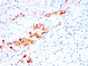 CD44v4 Antibody for IHC Bladder Tissue. Immunohistochemistry analysis of CD44 variant 4 / CD44 expression in FFPE human bladder tissue using recombinant mouse monoclonal antibody clone rCD44v4/1219. Membranous HRP-DAB brown staining is observed in epithelial cells lining glandular and luminal structures, highlighting cell borders and demonstrating focal epithelial organization within the surrounding stroma consistent with CD44v4-associated tissue architecture. The staining pattern emphasizes structural variation and supports its use for evaluating epithelial morphology and organization in bladder tissue. Heat induced epitope retrieval was performed by steaming tissue sections in pH 9 10mM Tris with 1mM EDTA buffer for 10-20 min.