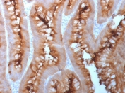 CEA Antibody Human Colon Carcinoma Tissue IHC. Immunohistochemistry analysis of CEA / CEACAM5 expression in FFPE human colon carcinoma using recombinant rabbit monoclonal antibody clone C66/1983R. This CEA antibody demonstrates strong apical membranous and luminal HRP-DAB brown staining in tumor epithelial cells forming glandular structures, with additional cytoplasmic signal, while surrounding stromal components remain largely negative; nuclei are counterstained blue. The staining pattern is consistent with the known epithelial localization of carcinoembryonic antigen in colorectal carcinoma.