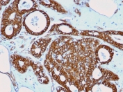 Beta-Catenin Transcriptional Marker Breast Carcinoma IHC. Immunohistochemistry analysis of human breast carcinoma using Beta-Catenin Antibody (clone rCTNNB1/2173) reveals strong cytoplasmic and membranous staining in tumor epithelial cells, consistent with CTNNB1 / Catenin beta-1 localization, with focal regions showing increased intracellular distribution relative to junctional staining. This pattern is consistent with beta-catenin redistribution observed during Wnt pathway activation and transcriptional signaling. Neoplastic glandular structures are well defined, while adjacent stromal components display comparatively low background staining. Hematoxylin counterstain provides clear nuclear contrast and architectural context. HIER: boil FFPE tissue sections in 10 mM Tris with 1 mM EDTA, pH 9, for 10-20 min followed by cooling at RT for 20 min.