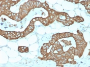 Immunohistochemistry analysis of KRT19 / Keratin 19 antibody (clone KRT19/1959R) in human colon tissue. Formalin-fixed, paraffin-embedded human colon tissue was stained using recombinant KRT19 / Keratin 19 antibody (clone KRT19/1959R). Heat-induced epitope retrieval was performed by boiling tissue sections in 10 mM Tris with 1 mM EDTA, pH 9.0, for 10-20 minutes, followed by cooling at room temperature prior to antibody incubation. Brown chromogenic signal is observed in glandular epithelial cells lining colonic crypts, with strong cytoplasmic and membranous staining outlining epithelial structures, while surrounding stromal and adipose tissue shows little to no staining. This staining pattern reflects epithelial-associated expression of Keratin 19 in colonic epithelium.