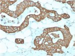 Immunohistochemistry analysis of KRT19 / Keratin 19 antibody (clone KRT19/1959R) in human colon tissue. Formalin-fixed, paraffin-embedded human colon tissue was stained using recombinant KRT19 / Keratin 19 antibody (clone KRT19/1959R). Heat-induced epitope retrieval was performed by boiling tissue sections in 10 mM Tris with 1 mM EDTA, pH 9.0, for 10-20 minutes, followed by cooling at room temperature prior to antibody incubation. Brown chromogenic signal is observed in glandular epithelial cells lining colonic crypts, with strong cytoplasmic and membranous staining outlining epithelial structures, while surrounding stromal and adipose tissue shows little to no staining. This staining pattern reflects epithelial-associated expression of Keratin 19 in colonic epithelium.