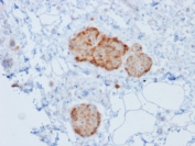 Immunohistochemistry of Recombinant CHGA Antibody in human pancreas. Formalin-fixed, paraffin-embedded human pancreatic tissue stained with recombinant CHGA antibody (clone rCHGA/777) demonstrates strong cytoplasmic granular staining within islets of Langerhans, consistent with Chromogranin A expression in pancreatic neuroendocrine cells, while surrounding exocrine acinar tissue is largely negative. Heat-induced epitope retrieval was performed by boiling tissue sections in 10mM citrate buffer, pH 6, for 10-20 minutes followed by cooling at room temperature for 20 minutes prior to testing.