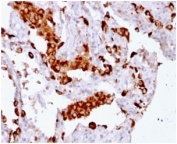 NAPSA Antibody for IHC. Immunohistochemistry analysis of Napsin A (NAPSA) expression in FFPE human lung adenocarcinoma demonstrates strong granular cytoplasmic HRP-DAB brown staining in tumor epithelial cells with minimal background in surrounding stromal regions. Clone rNAPSA/1239 highlights intracellular localization of Napsin A within vesicular compartments consistent with its role in secretory pathway protein trafficking and processing. HIER was performed by boiling tissue sections in pH 6 10mM citrate buffer for 10-20 minutes followed by cooling at RT for 20 minutes prior to staining.