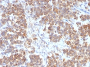 TNFSF15 Antibody Parathyroid Mass IHC. Immunohistochemistry staining of FFPE human parathyroid mass tissue using recombinant rabbit monoclonal clone VEGI/2052R demonstrates diffuse cytoplasmic HRP-DAB brown staining in neoplastic epithelial cells, consistent with expression of TNFSF15 / VEGI within endocrine-associated cellular populations. The observed staining pattern supports the involvement of this TNF superfamily cytokine in inflammatory and tissue regulatory signaling pathways. Required HIER: boil sections in 10mM Tris with 1mM EDTA, pH9, for 10-20 min followed by cooling at room temperature for 20 min.