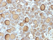 TG Antibody Recombinant Rabbit MAb TGB/1970R. Immunohistochemistry analysis of Thyroglobulin using TG Antibody Recombinant Rabbit MAb TGB/1970R in FFPE human thyroid gland tissue section. HRP-DAB brown chromogenic staining highlights strong cytoplasmic signal in thyroid follicular epithelial cells forming thyroid follicles, with prominent staining of follicular luminal colloid material reflecting abundant secreted Thyroglobulin. The staining pattern is characteristic of Thyroglobulin expression in differentiated thyroid follicular epithelium, while surrounding stromal and interfollicular regions show minimal staining.