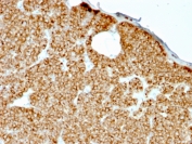 Parathyroid Hormone Antibody Recombinant Mouse MAb rPTH/911 immunohistochemistry analysis of PTH in human parathyroid gland tissue. FFPE human parathyroid gland tissue was stained using Parathyroid Hormone antibody clone rPTH/911 following heat induced epitope retrieval by boiling tissue sections in pH 6 citrate buffer (10mM) for 10-20 minutes prior to cooling and staining. HRP-DAB brown chromogenic signal highlights strong cytoplasmic staining in parathyroid endocrine chief cells arranged in dense nests, consistent with the known expression of Parathyroid hormone (PTH), a key regulator of calcium homeostasis produced by parathyroid gland cells. This staining pattern supports the use of Parathyroid Hormone Antibody Recombinant Mouse MAb (clone rPTH/911) for immunohistochemistry analysis of PTH expression in FFPE tissue sections and for studies involving parathyroid gland biology and PTH immunohistochemistry in endocrine tissues.