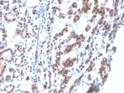 TF-1 Antibody Human Thyroid Tissue IHC. Formalin-fixed, paraffin-embedded human thyroid tissue stained using TTF-1 Antibody. The recombinant mouse monoclonal clone rNX2.1/690 antibody demonstrates strong nuclear staining in thyroid follicular epithelial cells, consistent with the nuclear localization of Thyroid transcription factor 1 (NKX2-1). NKX2-1 is a lineage-associated transcription factor expressed in thyroid follicular epithelium and pulmonary epithelial cells, and thyroid tissue therefore provides a well-established positive epithelial lineage control for TTF-1 antibody staining. In diagnostic immunohistochemistry, nuclear TTF-1 expression is widely used as a marker of pulmonary adenocarcinoma and other tumors derived from NKX2-1 expressing epithelial lineages. Required HIER: boil tissue sections in pH6 10mM citrate buffer for 10-20 min followed by cooling at RT for 20 min.