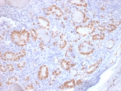 Immunohistochemistry of TTF-1 Antibody / Lung Adenocarcinoma Marker Antibody in human lung adenocarcinoma. Formalin-fixed, paraffin-embedded human lung adenocarcinoma tissue stained using TTF-1 Antibody / Lung Adenocarcinoma Marker Antibody. The recombinant mouse monoclonal clone rNX2.1/690 antibody shows strong nuclear immunoreactivity in malignant pulmonary epithelial cells, highlighting tumor cells of pulmonary origin. Nuclear staining of Thyroid transcription factor 1 (NKX2-1) is a well-established diagnostic feature of pulmonary adenocarcinoma and is widely used in immunohistochemistry panels to distinguish primary lung adenocarcinoma from metastatic carcinomas involving the lung. This staining pattern supports the role of TTF-1 as a lineage-defining pulmonary tumor marker and a key immunohistochemical marker for lung adenocarcinoma identification in surgical pathology. Required HIER: boil tissue sections in pH6 10mM citrate buffer for 10-20 min followed by cooling at RT for 20 min.