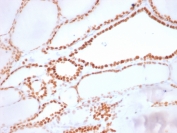 NKX2.1 Antibody / Forebrain Thyroid Development Marker Antibody (clone NX2.1/1855R). Immunohistochemistry analysis of human thyroid tissue. FFPE human thyroid sections demonstrate strong HRP-DAB brown nuclear staining in thyroid follicular epithelial cells lining the thyroid follicles, consistent with expression of the NKX2.1 developmental homeobox transcription factor. The nuclear staining pattern highlights NKX2.1 as a transcription factor involved in thyroid organogenesis and early thyroid epithelial lineage specification. Positive nuclei are distributed throughout follicular epithelial cells surrounding colloid-filled follicles, reflecting transcriptional programs associated with thyroid developmental regulation. This staining pattern is consistent with NKX2.1 activity as a marker of thyroid developmental lineage identity. Surrounding stromal elements show minimal staining. Required HIER: boil tissue sections in pH6, 10mM citrate buffer, for 10-20 minutes followed by cooling at room temperature for 20 minutes prior to antibody incubation.