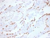 NKX2.1 Antibody Lung Adenocarcinoma IHC (clone NX2.1/1855R). Immunohistochemistry analysis of human lung adenocarcinoma tissue. FFPE human lung adenocarcinoma sections demonstrate strong HRP-DAB brown nuclear staining in tumor epithelial cells, consistent with expression of the NKX2.1 developmental homeobox transcription factor that participates in early lineage specification programs shared between lung and thyroid developmental pathways. Positive tumor cell nuclei are distributed throughout the carcinoma cell population, reflecting transcriptional programs associated with NKX2.1-mediated developmental regulation of epithelial lineage identity. The nuclear staining pattern highlights the role of NKX2.1 as a developmental transcription factor originally characterized in studies of ventral forebrain patterning and thyroid organogenesis. Surrounding stromal cells and non-epithelial elements show minimal staining. Required HIER: boil tissue sections in pH6, 10mM citrate buffer, for 10-20 minutes followed by cooling at room temperature for 20 minutes prior to antibody incubation.