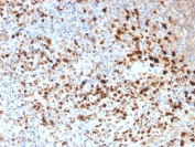 IHC staining of FFPE human cervix with HSV1 antibody (clone HSV1/1934). Required HIER: boil tissue sections in pH6, 10mM citrate buffer, for 10-20 min followed by cooling at RT for 20 min.