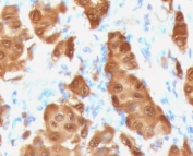 Immunohistochemistry analysis of S100B / Melanoma Marker antibody (clone PS1B1-2R) in human melanoma tissue. FFPE human melanoma demonstrates strong cytoplasmic and nuclear HRP-DAB brown staining in malignant melanocytic cells, consistent with S100B expression. Tumor cells show diffuse and intense staining, while surrounding stromal elements display comparatively weaker signal. Nuclei are counterstained blue. Heat induced epitope retrieval was performed by steaming sections in 10 mM Tris with 1 mM EDTA, pH 9.0, for 10-20 minutes prior to immunostaining.