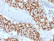 Cyclin E1 Antibody Human Colon Carcinoma Nuclear IHC. Immunohistochemistry staining of FFPE human colon carcinoma tissue using Cyclin E1 Antibody / G1-S Cell Cycle Regulator Antibody (clone CCNE1/2460) demonstrates strong nuclear HRP-DAB brown staining throughout a large proportion of malignant epithelial cells. The intense nuclear localization is consistent with expression of Cyclin E1 (CCNE1), a key regulator of the G1-S transition that controls entry into DNA replication through activation of CDK2-dependent cell cycle pathways. The high frequency of Cyclin E1-positive nuclei observed within tumor cell populations is consistent with active cellular proliferation and the established role of Cyclin E1 in cell cycle progression, growth regulation, and oncogenic signaling. HIER: boil tissue sections in pH 6, 10 mM citrate buffer for 10-20 minutes followed by cooling at room temperature for 20 minutes before testing.