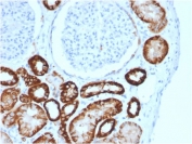 Cadherin 16 Antibody Kidney Tumor IHC. Immunohistochemical analysis of Cadherin-16 / CDH16 expression in formalin-fixed, paraffin-embedded human renal cell carcinoma tissue using Cadherin 16 antibody clone CDH16/2125. Distinct membranous and cytoplasmic staining is observed in carcinoma cells forming tubular and gland-like structures, while surrounding stromal regions show minimal background. The staining pattern aligns with kidney-restricted expression and supports the identification of renal epithelial origin in tumor tissue. Required HIER: boil tissue sections in 10mM citrate buffer, pH6, for 10-20 min followed by cooling at RT for 20 min.