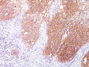 EGF Receptor Antibody Lung Squamous Cell Carcinoma IHC. Immunohistochemistry testing of FFPE human lung squamous cell carcinoma with EGF Receptor antibody (clone GFR/1667). HIER: boil tissue sections in pH 9 10mM Tris with 1mM EDTA for 20 min and allow to cool before testing.