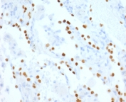 NKX2.1 Antibody Lung Adenocarcinoma IHC (clone HBNK2-2R). Immunohistochemistry analysis of human lung adenocarcinoma tissue. FFPE human lung adenocarcinoma sections demonstrate strong HRP-DAB brown nuclear staining in tumor epithelial cells, consistent with expression of the NKX2.1 thyroid transcription factor within pulmonary tumor cells. Positive nuclei are distributed throughout the carcinoma cell population, reflecting activation of NKX2.1-regulated epithelial transcriptional programs that are characteristic of this lineage transcription factor. The nuclear staining pattern highlights the role of NKX2.1 as a transcription factor that regulates epithelial gene expression programs associated with thyroid lineage transcriptional control. Surrounding stromal cells and non-epithelial elements show minimal staining. Required HIER: boil tissue sections in pH6, 10mM citrate buffer, for 10-20 minutes followed by cooling at room temperature for 20 minutes prior to antibody incubation.