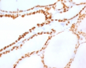 NKX2.1 Antibody / Thyroid Transcription Factor Antibody (clone HBNK2-2R). Immunohistochemistry analysis of human thyroid tissue. FFPE human thyroid sections demonstrate strong HRP-DAB brown nuclear staining in thyroid follicular epithelial cells lining the thyroid follicles, consistent with expression of the NKX2.1 thyroid lineage transcription factor within differentiated thyroid epithelium. The nuclear staining pattern highlights NKX2.1 as a key thyroid transcription factor regulating gene expression programs that control thyroid epithelial differentiation and thyroid hormone biosynthesis. Positive nuclei are distributed throughout follicular epithelial cells surrounding colloid-filled follicles, reflecting the role of NKX2.1 in maintaining transcriptional regulation of thyroid-specific genes within thyroid follicular cells. Surrounding stromal cells and non-epithelial elements show minimal staining. Required HIER: boil tissue sections in pH6, 10mM citrate buffer, for 10-20 minutes followed by cooling at room temperature for 20 minutes prior to antibody incubation.