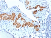 SMMHC Antibody Breast Carcinoma IHC. Immunohistochemical staining of FFPE human breast carcinoma demonstrates expression of Smooth Muscle Myosin Heavy Chain using recombinant SMMHC antibody clone MYH11/2303R. SMMHC, encoded by the MYH11 gene, is a highly specific marker of differentiated smooth muscle and myoepithelial cells. Strong cytoplasmic staining highlights residual myoepithelial cells surrounding glandular structures, consistent with the utility of SMMHC in distinguishing invasive from in situ breast lesions. Heat induced epitope retrieval was performed by boiling tissue sections in pH 9 10 mM Tris with 1 mM EDTA for 10-20 minutes followed by cooling at room temperature for 20 minutes. These results support the utility of SMMHC Antibody for studies of myoepithelial differentiation, breast pathology, and smooth muscle biology.