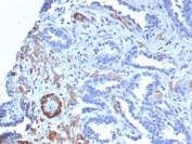 SMMHC Antibody Prostate Carcinoma IHC. Immunohistochemical staining of FFPE human prostate carcinoma demonstrates Smooth Muscle Myosin Heavy Chain expression using SMMHC antibody clone MYH11/2303R. SMMHC, encoded by the MYH11 gene, is a highly specific marker of differentiated smooth muscle and prostatic basal-associated stromal elements. Distinct cytoplasmic staining highlights smooth muscle bundles and vascular walls surrounding malignant glands, while neoplastic epithelial cells show little to no reactivity. Preservation or loss of SMMHC-positive structures provides valuable information in the histopathologic evaluation of prostatic lesions. Heat induced epitope retrieval was performed by boiling tissue sections in pH 9 10 mM Tris with 1 mM EDTA for 10-20 minutes followed by cooling at room temperature for 20 minutes. These results support the utility of SMMHC Antibody for studies of prostate pathology, smooth muscle differentiation, and stromal architecture.
