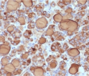 Thyroglobulin Antibody Recombinant Rabbit MAb TG157-3R. Immunohistochemistry analysis of Thyroglobulin using Thyroglobulin Antibody Recombinant Rabbit MAb TG157-3R in FFPE human thyroid carcinoma tissue section. HRP-DAB brown chromogenic staining highlights strong cytoplasmic signal in thyroid follicular tumor epithelial cells forming follicular structures, with prominent staining of follicular luminal colloid material reflecting abundant secreted Thyroglobulin. The staining pattern is consistent with the known localization of Thyroglobulin in differentiated thyroid follicular epithelium and thyroid-derived carcinomas, while surrounding stromal elements show minimal staining.