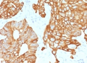 Immunohistochemistry analysis of recombinant Cytokeratin 19 / CK19 antibody (clone CTKN19-2R) in human colon tissue. Formalin-fixed, paraffin-embedded human colon tissue was stained using recombinant Cytokeratin 19 antibody (clone CTKN19-2R). Heat-induced epitope retrieval was performed by boiling tissue sections in 10 mM citrate buffer, pH 6.0, for 10-20 minutes, followed by cooling at room temperature prior to antibody incubation. Brown chromogenic signal is observed in glandular epithelial cells lining colonic crypts, with strong cytoplasmic and membranous staining outlining epithelial structures, while surrounding stromal tissue shows little to no staining. This staining pattern reflects epithelial-associated expression of Cytokeratin 19 in colonic epithelium.