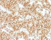 Parathyroid Hormone IHC Antibody immunohistochemistry analysis of PTH in human parathyroid gland tissue. FFPE human parathyroid gland tissue was stained using Parathyroid Hormone antibody clone PRTM1-1R following heat induced epitope retrieval by steaming sections in pH 9 Tris-EDTA buffer (10mM Tris, 1mM EDTA) for 10-20 minutes prior to staining. HRP-DAB brown chromogenic signal highlights strong cytoplasmic staining in parathyroid endocrine chief cells, consistent with the known localization of Parathyroid hormone (PTH), a key regulator of calcium homeostasis produced by parathyroid gland cells. The staining pattern demonstrates robust detection of hormone-producing parathyroid tissue and supports the use of Parathyroid Hormone IHC Antibody / PTH Antibody (clone PRTM1-1R) for immunohistochemistry analysis of PTH expression in FFPE tissue sections.