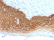 CD44v3 Antibody for IHC Cervical Carcinoma. Immunohistochemistry analysis of CD44 variant 3 / CD44 expression in FFPE human cervical carcinoma using mouse monoclonal antibody clone 3G5. Membranous HRP-DAB brown staining is observed in malignant epithelial cells, highlighting cell surface localization consistent with CD44v3-associated co-receptor activity and growth factor signaling. The staining pattern supports its role in tumor cell signaling and microenvironmental interaction within cervical carcinoma tissue. Heat induced epitope retrieval was performed by steaming tissue sections in pH 9 10mM Tris with 1mM EDTA buffer for 10-20 min.