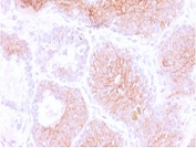 CD44v3 Antibody for IHC Prostate Carcinoma. Immunohistochemistry analysis of CD44 variant 3 / CD44 expression in FFPE human prostate carcinoma using mouse monoclonal antibody clone CDLA44v3-1. Membranous HRP-DAB brown staining is observed in malignant epithelial cells, outlining tumor glands and highlighting cell surface localization consistent with CD44v3-associated cell interaction and extracellular matrix engagement. The staining pattern supports its role in tumor microenvironment organization and cell-stroma interface within prostate carcinoma tissue. Heat induced epitope retrieval was performed by steaming tissue sections in pH 9 10mM Tris with 1mM EDTA buffer for 10-20 min.
