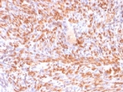 Recombinant Calponin Antibody Human Uterus Tissue IHC. Immunohistochemistry staining of FFPE human uterus with recombinant Calponin antibody (clone rCNN1/832). Required HIER: boil tissue sections in 1mM EDTA, pH 7.5-8.5, for 10-20 min followed by cooling at RT for 20 min.