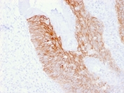 CD44v6 Antibody for IHC Cervical Carcinoma. Immunohistochemistry analysis of CD44 variant 6 / CD44 expression in FFPE human cervix carcinoma using mouse monoclonal antibody clone 2F10. Strong membranous HRP-DAB brown staining is observed in malignant epithelial cells, outlining tumor nests and highlighting cell surface localization consistent with CD44v6-associated adhesion, tumor invasion, and metastatic potential. The staining pattern emphasizes carcinoma cell organization and supports its role in invasive behavior and progression within cervical cancer tissue. Heat induced epitope retrieval was performed by boiling tissue sections in pH 9 10mM Tris with 1mM EDTA for 20 min followed by cooling at RT before testing.