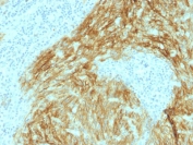 CD21 Antibody Follicular Dendritic Cell Sarcoma IHC. Immunohistochemistry of Complement Receptor 2 / CD21 in FFPE human follicular dendritic cell sarcoma tissue using CD21 antibody, clone CR2/1952. HRP-DAB brown staining highlights tumor cells with strong membranous and dendritic cytoplasmic patterns, consistent with follicular dendritic cell lineage and characteristic network formation, while surrounding non-neoplastic cells show minimal staining and nuclei are counterstained blue. Heat induced epitope retrieval was performed by boiling tissue sections in pH 6 10 mM citrate buffer for 10-20 min followed by cooling at RT prior to staining.