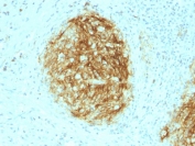 CD21 Antibody FDC Tumor IHC. Immunohistochemistry of Complement Receptor 2 / CD21 in FFPE human follicular dendritic cell sarcoma tissue using CD21 antibody, clone CR2/1953. HRP-DAB brown staining highlights tumor cells forming a compact nodular network with strong membranous and dendritic cytoplasmic signal, consistent with follicular dendritic cell origin, while surrounding stromal elements show minimal staining and nuclei are counterstained blue. Heat induced epitope retrieval was performed by boiling tissue sections in pH 6 10 mM citrate buffer for 10-20 min followed by cooling at RT prior to staining.