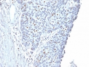 Immunohistochemistry analysis of Cyclin A2 / CCNA2 antibody in human endometrial carcinoma tissue. Formalin-fixed, paraffin-embedded human endometrial carcinoma tissue was stained using Cyclin A2 antibody. Heat-induced epitope retrieval was performed by steaming tissue sections in citrate buffer, pH 6.0, for 20 minutes, followed by cooling prior to antibody incubation. Brown chromogenic signal is observed predominantly in the nuclei of tumor epithelial cells, consistent with proliferative cell populations, while surrounding stromal cells show comparatively reduced staining. This nuclear staining pattern reflects cell cycle-associated expression of Cyclin A2 in endometrial carcinoma.