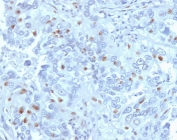 Immunohistochemistry analysis of CCNA2 / Cyclin A2 antibody (clone CNA2-1) in human endometrial carcinoma tissue. Formalin-fixed, paraffin-embedded human endometrial carcinoma tissue was stained using CCNA2 antibody (clone CNA2-1). Heat-induced epitope retrieval was performed by steaming tissue sections in citrate buffer, pH 6.0, for 20 minutes, followed by cooling prior to antibody incubation. Brown chromogenic signal is observed predominantly in the nuclei of scattered tumor epithelial cells, consistent with proliferative cell populations, while surrounding stromal cells show minimal staining. This nuclear staining pattern reflects cell cycle-associated expression of Cyclin A2 in endometrial carcinoma.